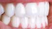 7 Foods for Healthy Teeth and Gums