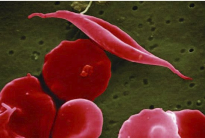 US Approves World’s First Crispr Gene-Editing Drug For Sickle-Cell Disease